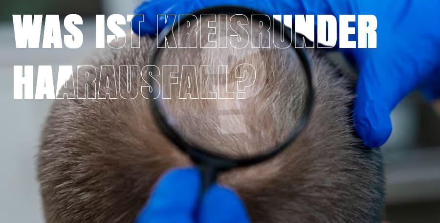 Was ist kreisrunder Haarausfall?